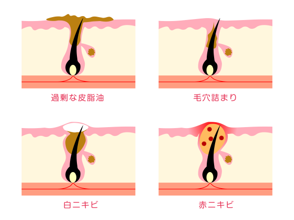 NOV,ac,アクティブ,毛穴,ニキビ,化粧品