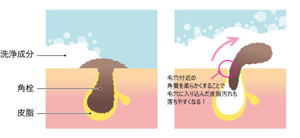 白ニキビ,原因,予防,ケア